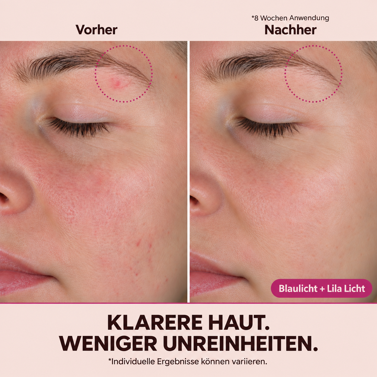 Slikglow | LED Rotlicht-Therapie Maske