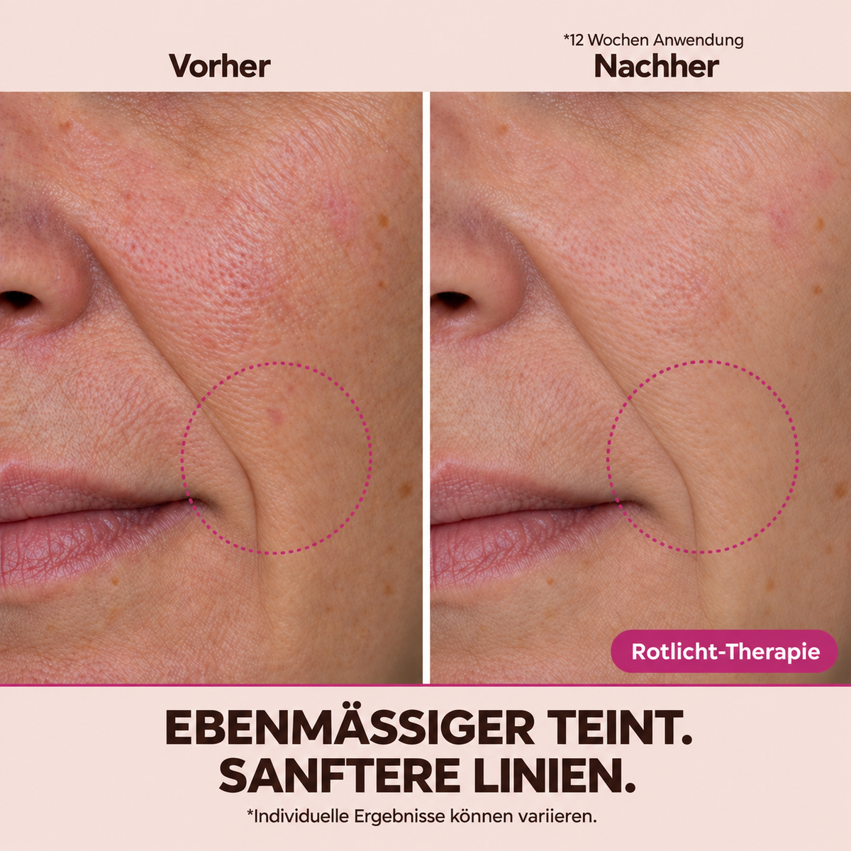 Slikglow | LED Rotlicht-Therapie Maske