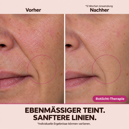Slikglow | LED Rotlicht-Therapie Maske